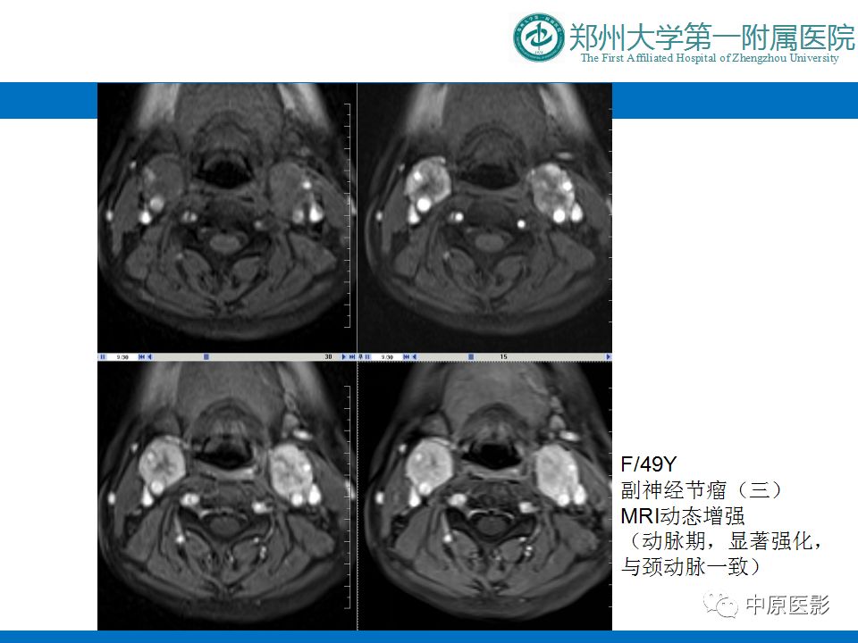 影像PPT - 【PPT】颈部神经源性肿瘤的磁共振成像-43