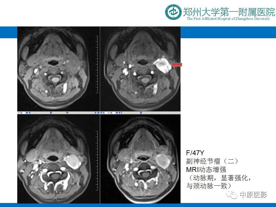 影像PPT - 【PPT】颈部神经源性肿瘤的磁共振成像-45