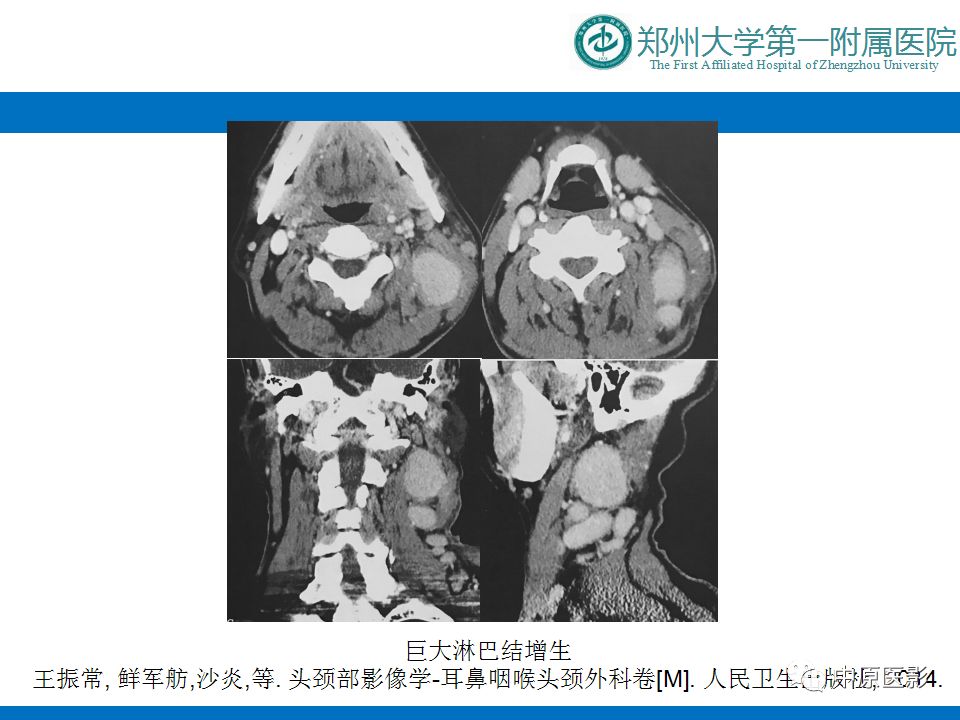 影像PPT - 【PPT】颈部神经源性肿瘤的磁共振成像-50
