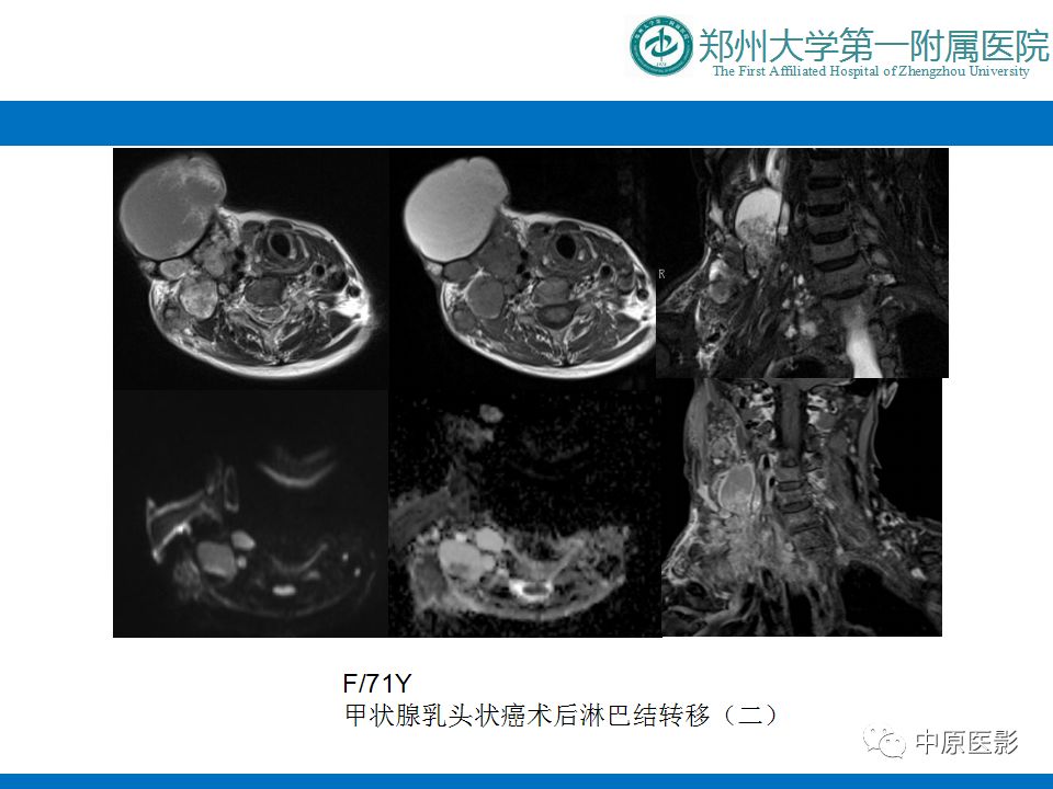 影像PPT - 【PPT】颈部神经源性肿瘤的磁共振成像-52