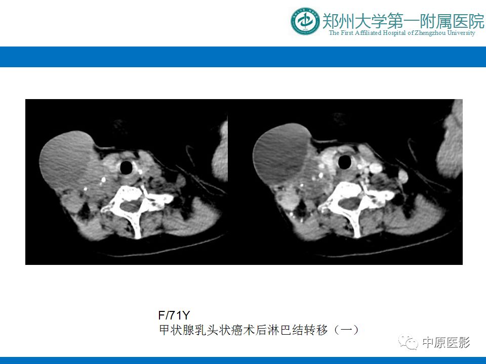 影像PPT - 【PPT】颈部神经源性肿瘤的磁共振成像-51