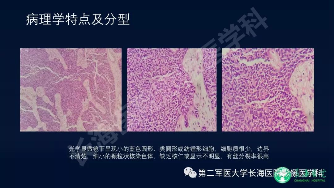 影像PPT - 【PPT】浅谈小细胞肺癌的影像诊断-4