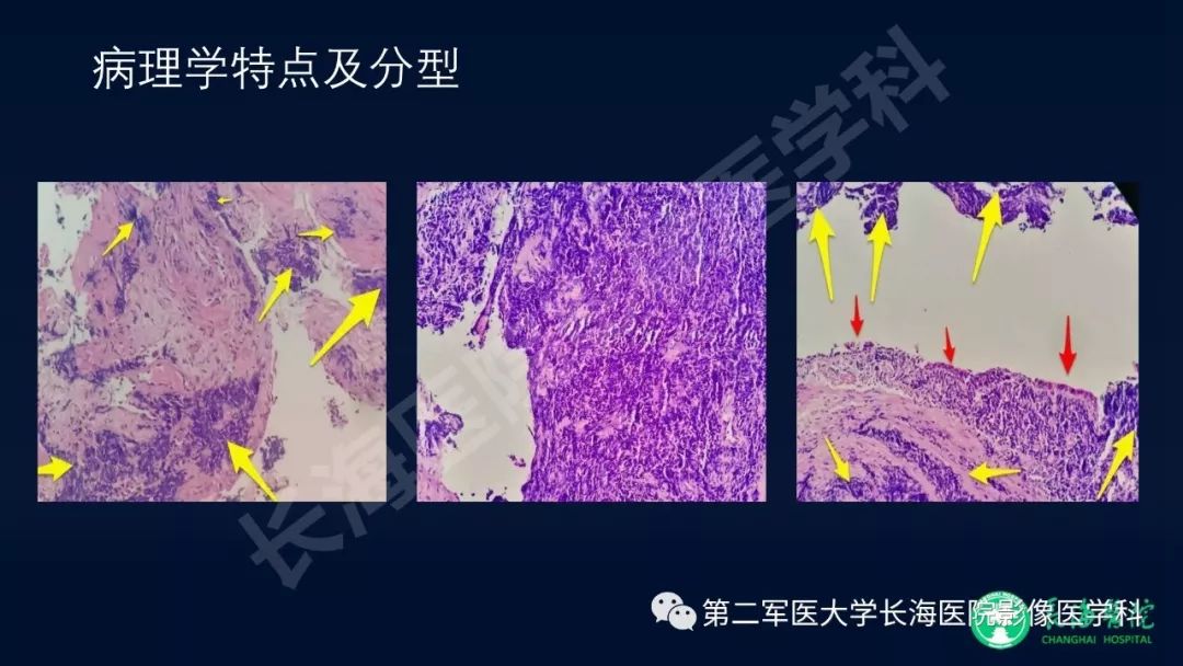 影像PPT - 【PPT】浅谈小细胞肺癌的影像诊断-5
