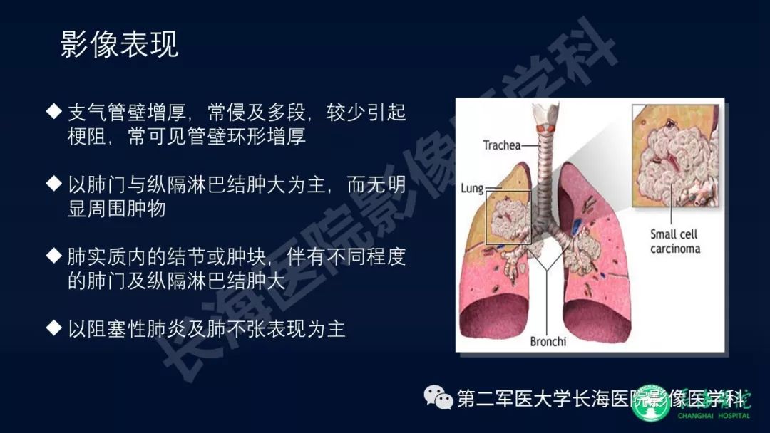 影像PPT - 【PPT】浅谈小细胞肺癌的影像诊断-12