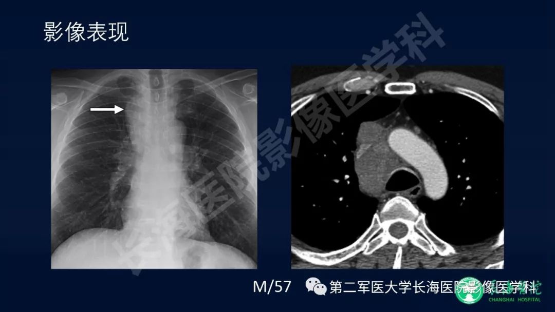 影像PPT - 【PPT】浅谈小细胞肺癌的影像诊断-14