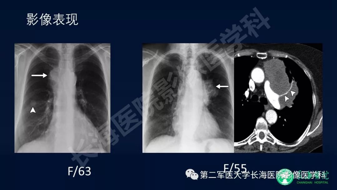 影像PPT - 【PPT】浅谈小细胞肺癌的影像诊断-15