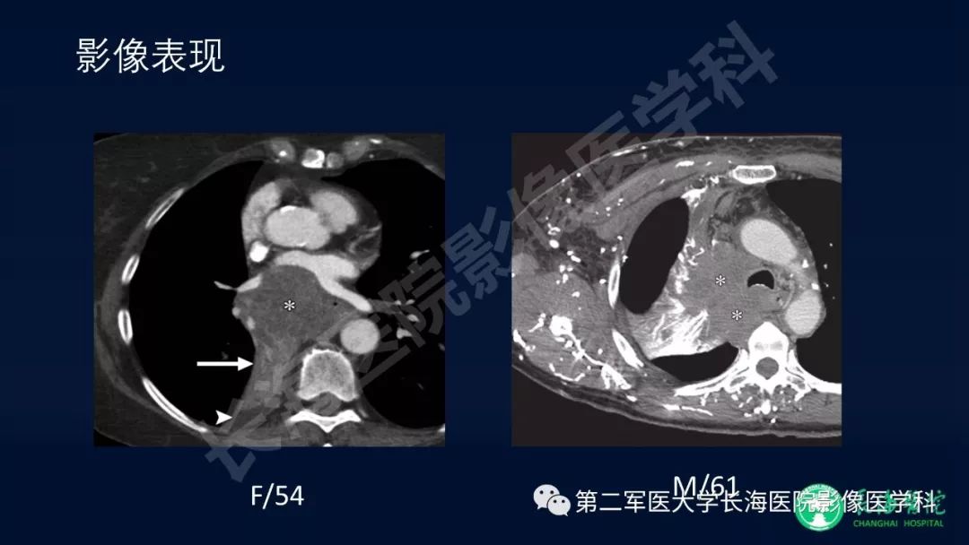 影像PPT - 【PPT】浅谈小细胞肺癌的影像诊断-16