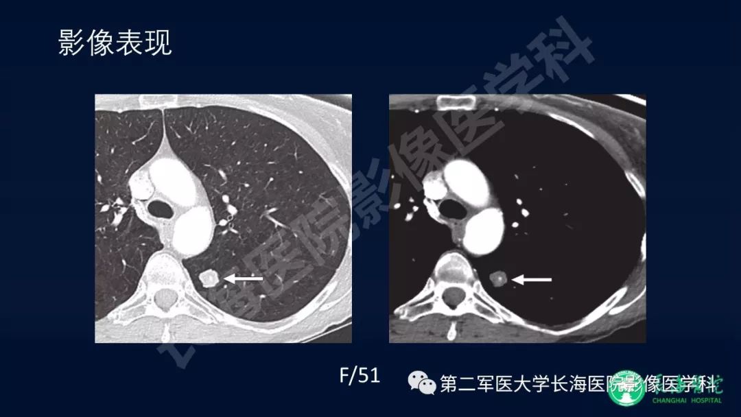 影像PPT - 【PPT】浅谈小细胞肺癌的影像诊断-17