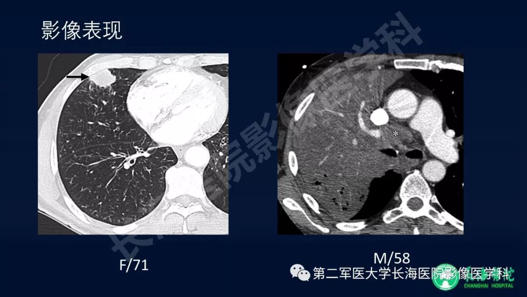 影像PPT - 【PPT】浅谈小细胞肺癌的影像诊断-18