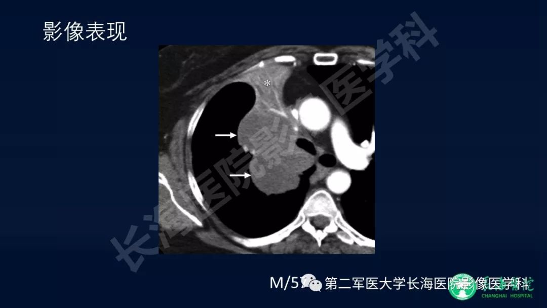 影像PPT - 【PPT】浅谈小细胞肺癌的影像诊断-19