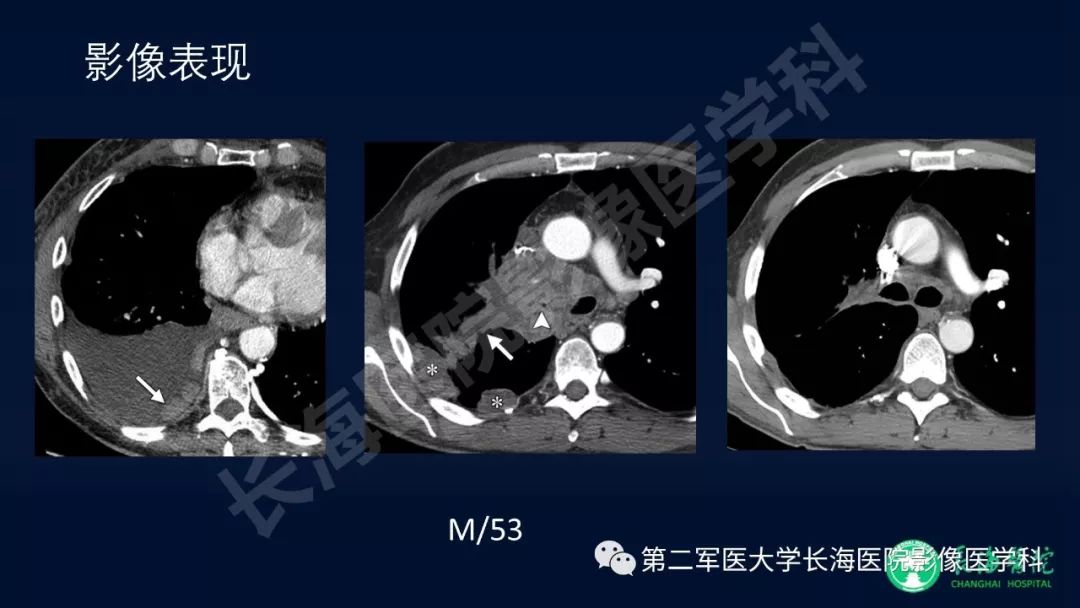 影像PPT - 【PPT】浅谈小细胞肺癌的影像诊断-20
