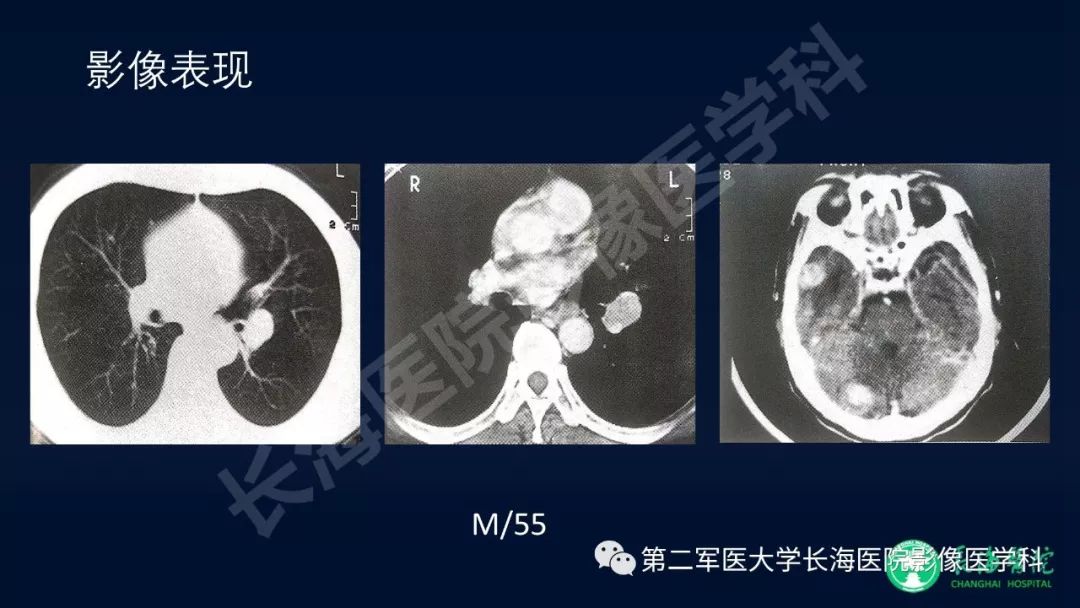 影像PPT - 【PPT】浅谈小细胞肺癌的影像诊断-21