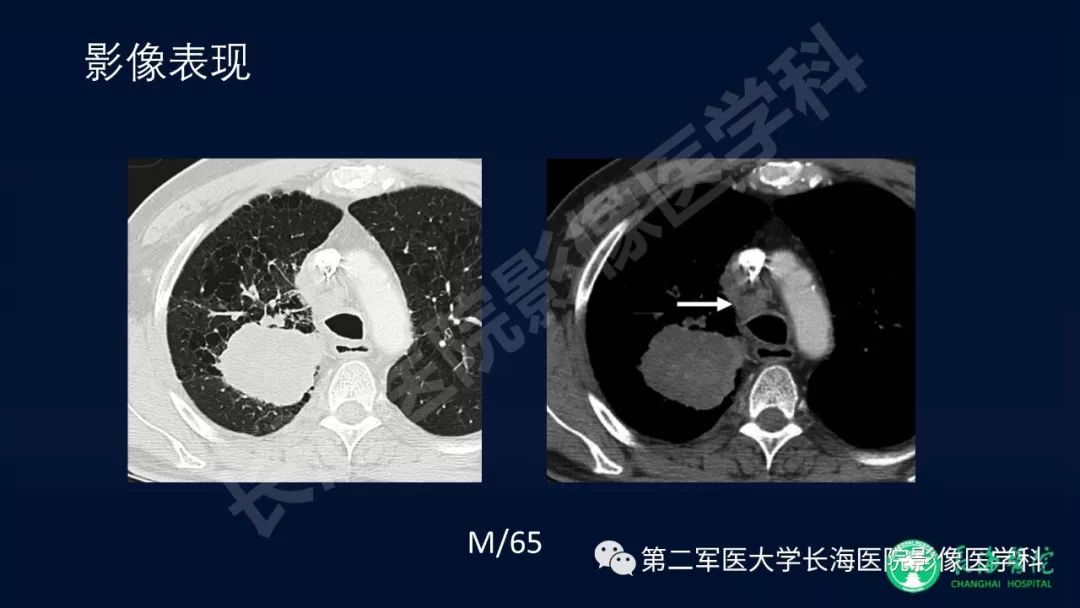 影像PPT - 【PPT】浅谈小细胞肺癌的影像诊断-13