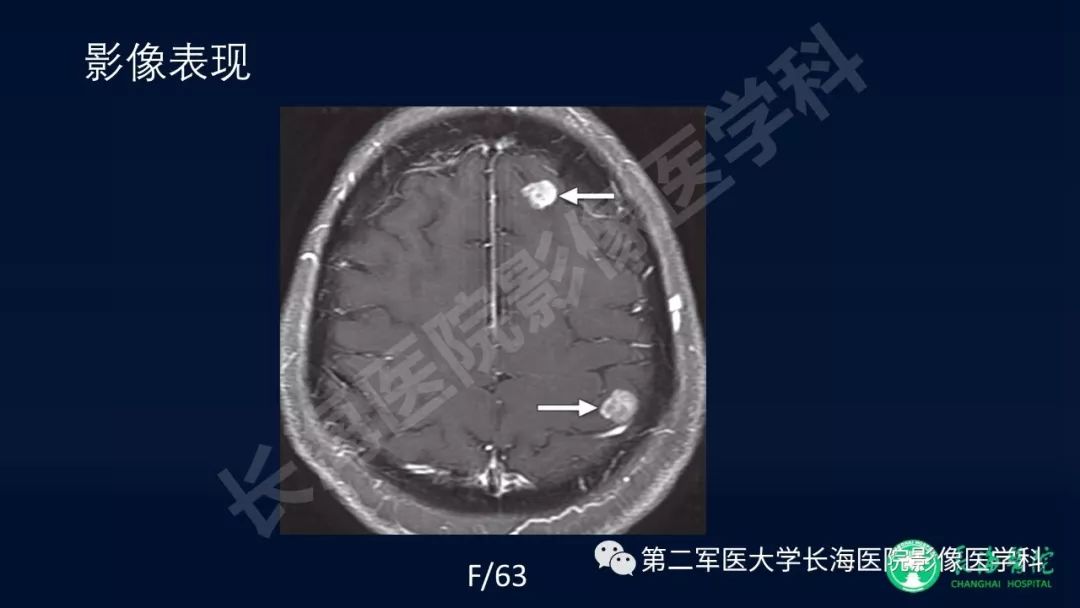 影像PPT - 【PPT】浅谈小细胞肺癌的影像诊断-22