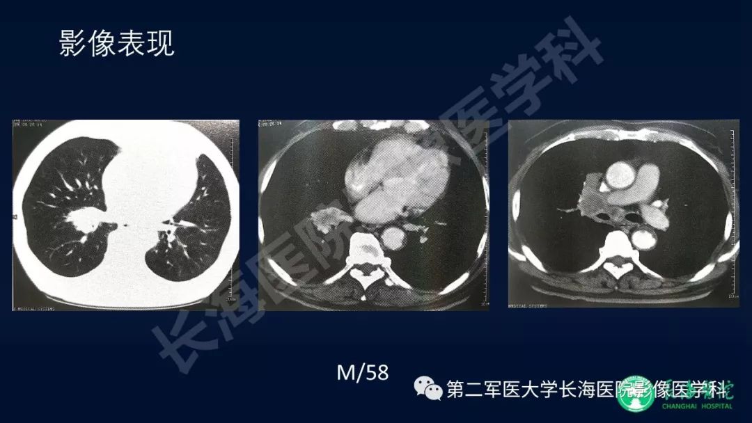 影像PPT - 【PPT】浅谈小细胞肺癌的影像诊断-23