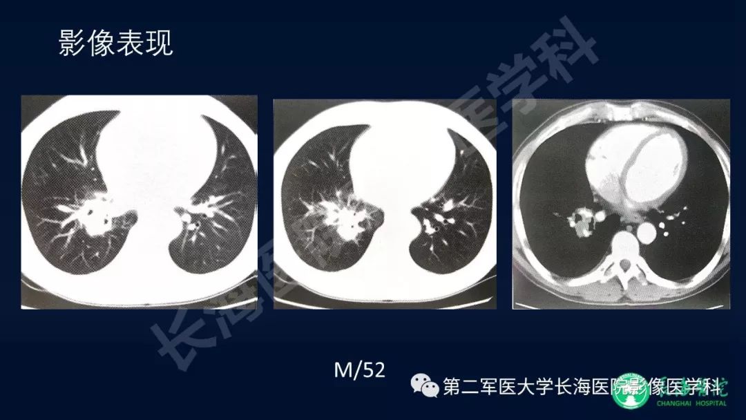 影像PPT - 【PPT】浅谈小细胞肺癌的影像诊断-24