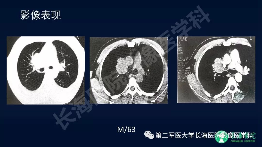 影像PPT - 【PPT】浅谈小细胞肺癌的影像诊断-25