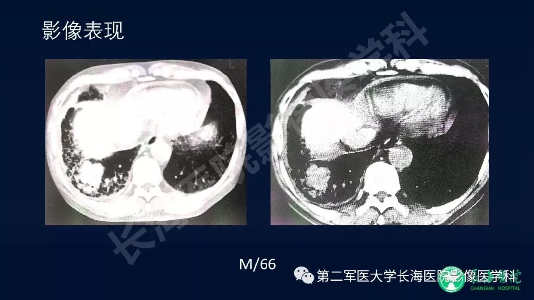 影像PPT - 【PPT】浅谈小细胞肺癌的影像诊断-26