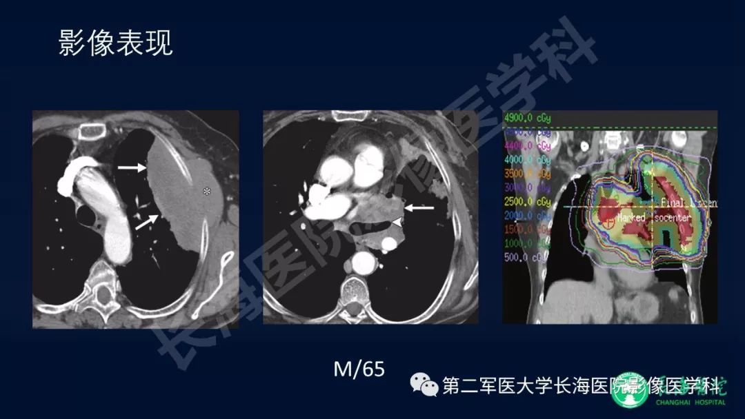 影像PPT - 【PPT】浅谈小细胞肺癌的影像诊断-27