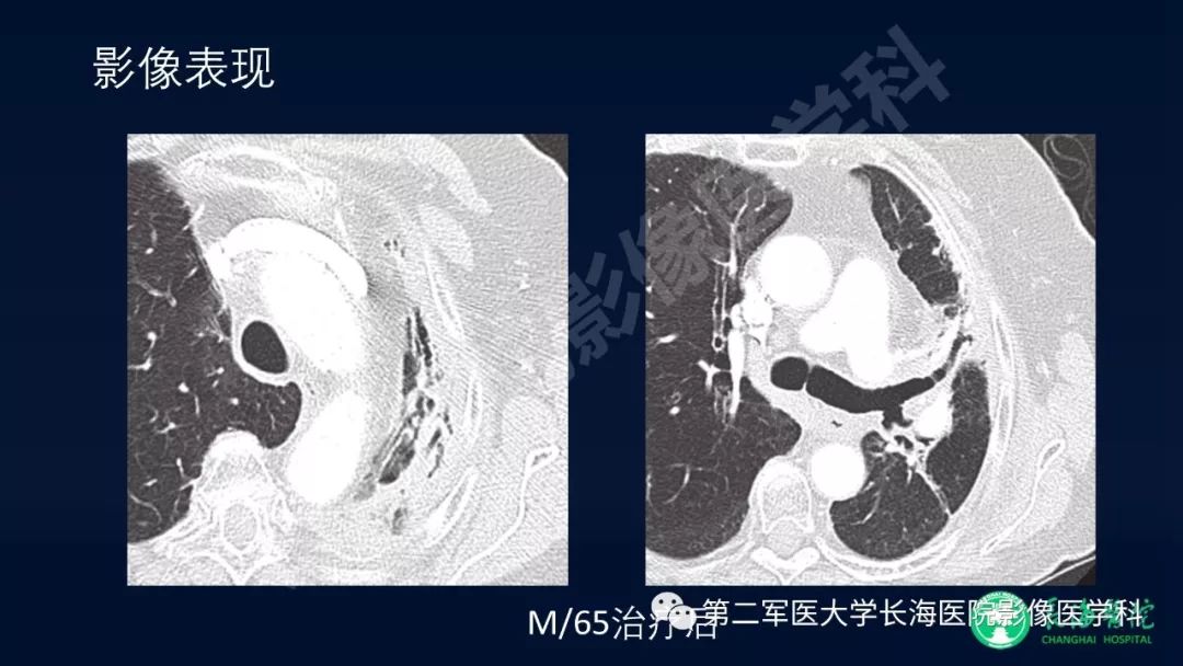 影像PPT - 【PPT】浅谈小细胞肺癌的影像诊断-28