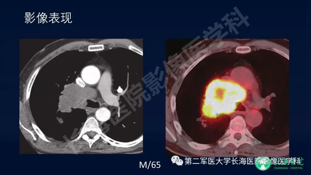 影像PPT - 【PPT】浅谈小细胞肺癌的影像诊断-29