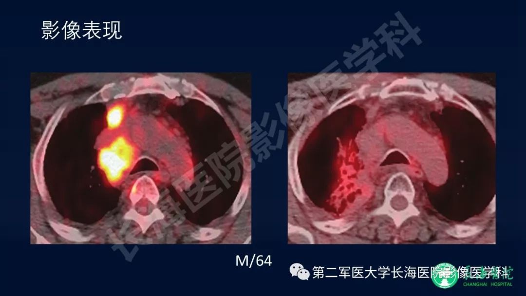 影像PPT - 【PPT】浅谈小细胞肺癌的影像诊断-30