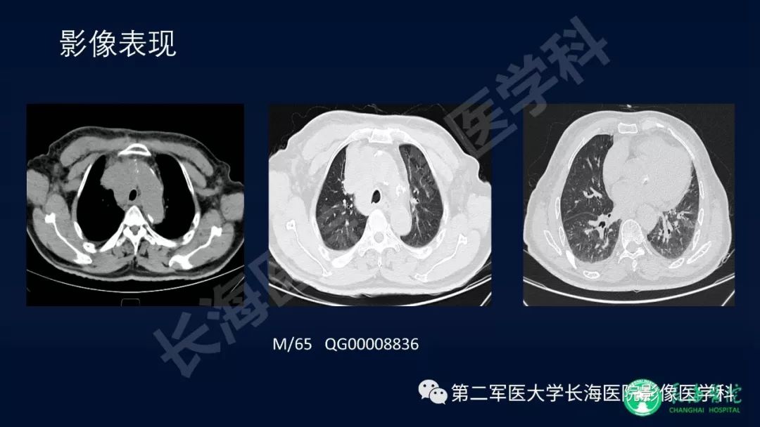影像PPT - 【PPT】浅谈小细胞肺癌的影像诊断-31