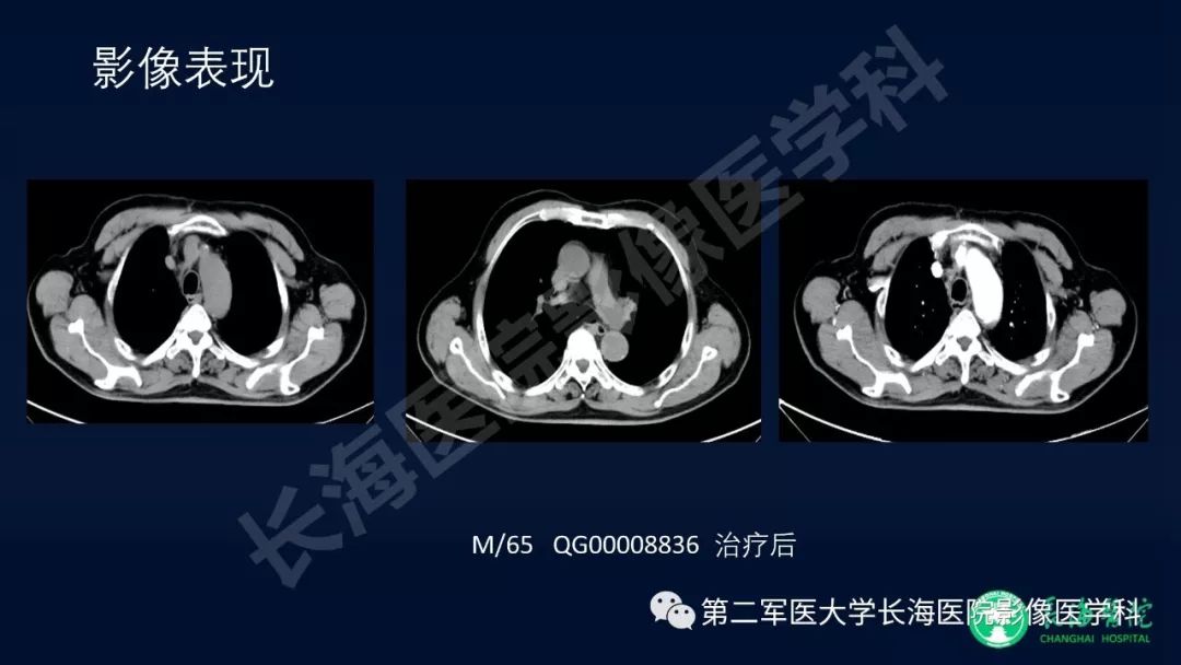 影像PPT - 【PPT】浅谈小细胞肺癌的影像诊断-32