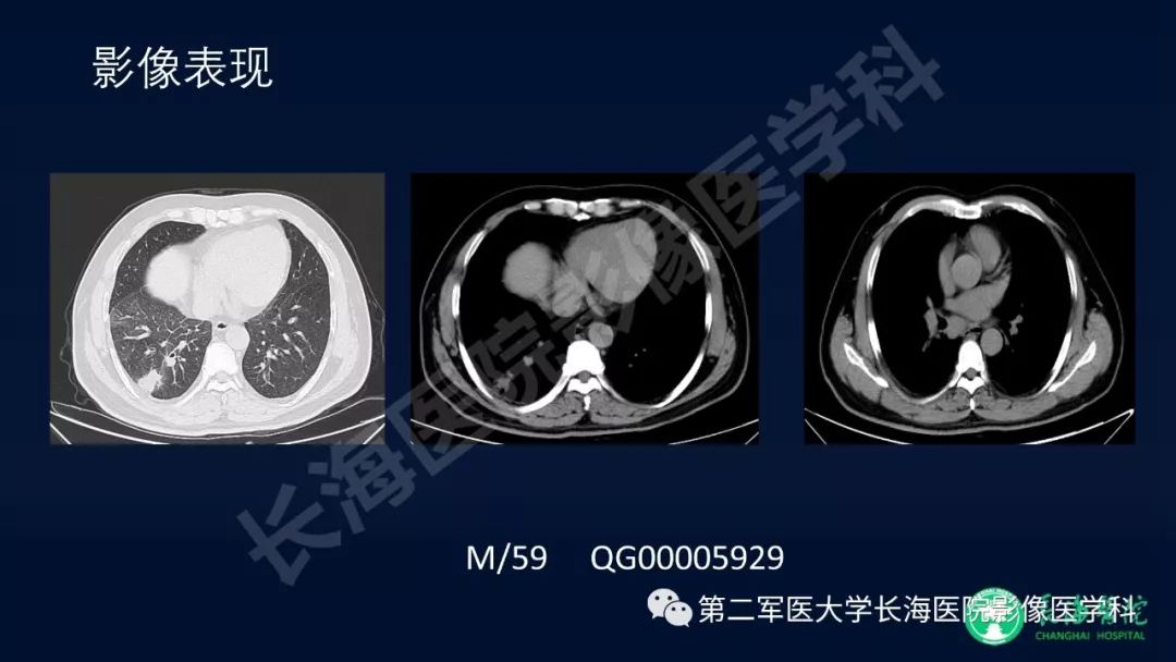 影像PPT - 【PPT】浅谈小细胞肺癌的影像诊断-33