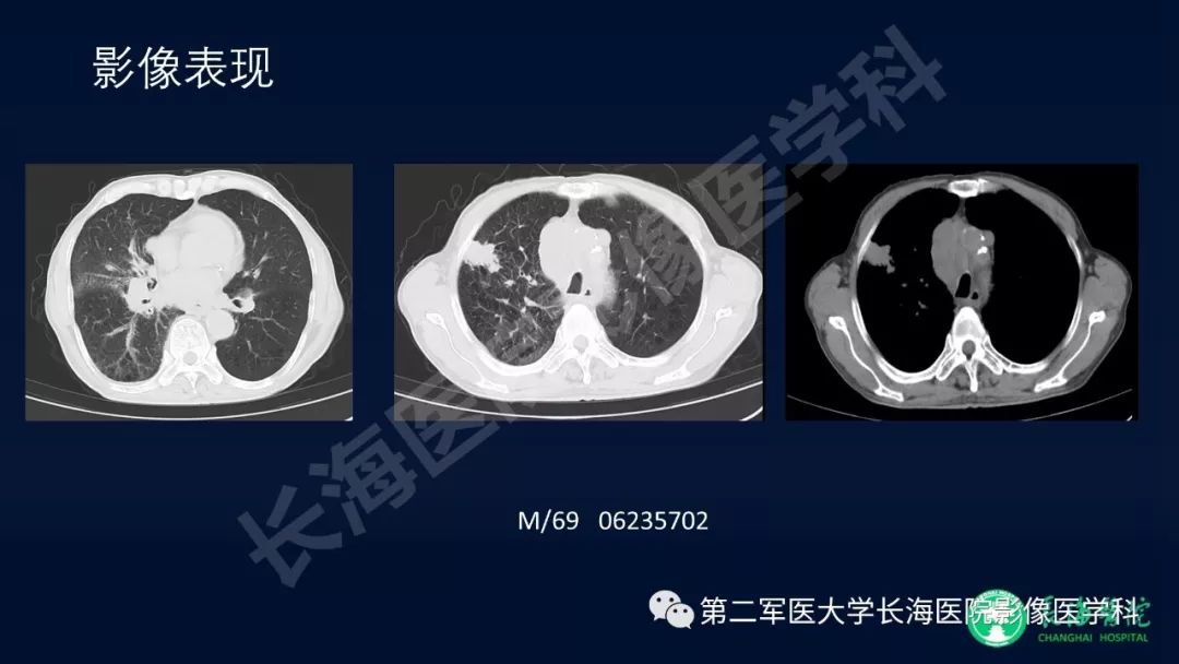 影像PPT - 【PPT】浅谈小细胞肺癌的影像诊断-34