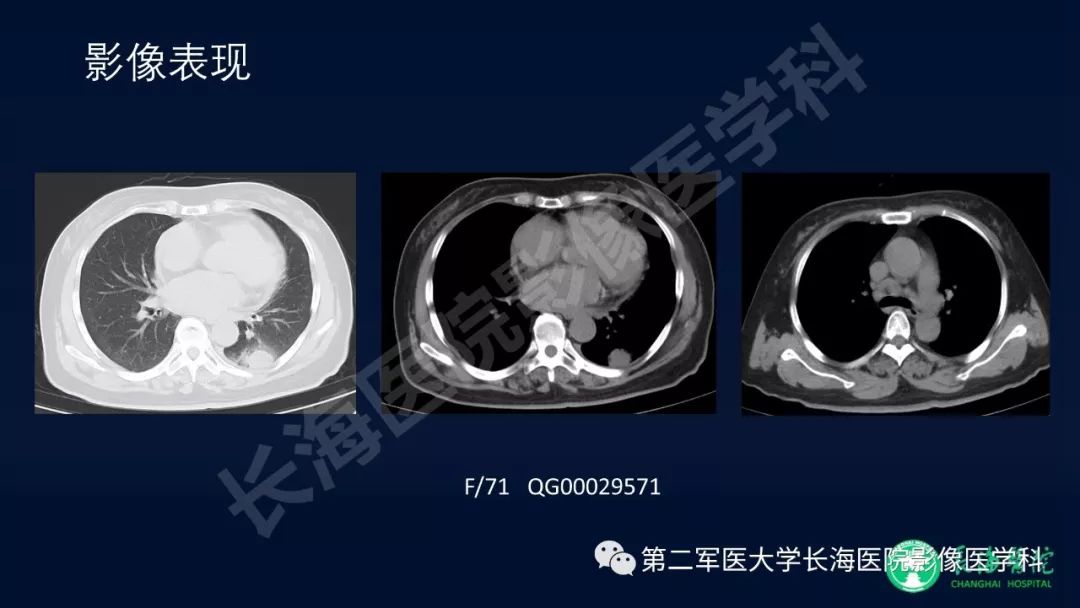 影像PPT - 【PPT】浅谈小细胞肺癌的影像诊断-35