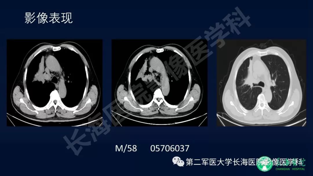 影像PPT - 【PPT】浅谈小细胞肺癌的影像诊断-36