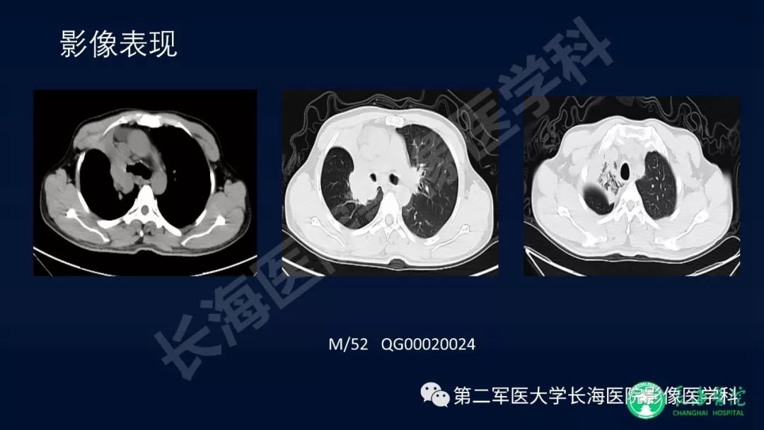 影像PPT - 【PPT】浅谈小细胞肺癌的影像诊断-37