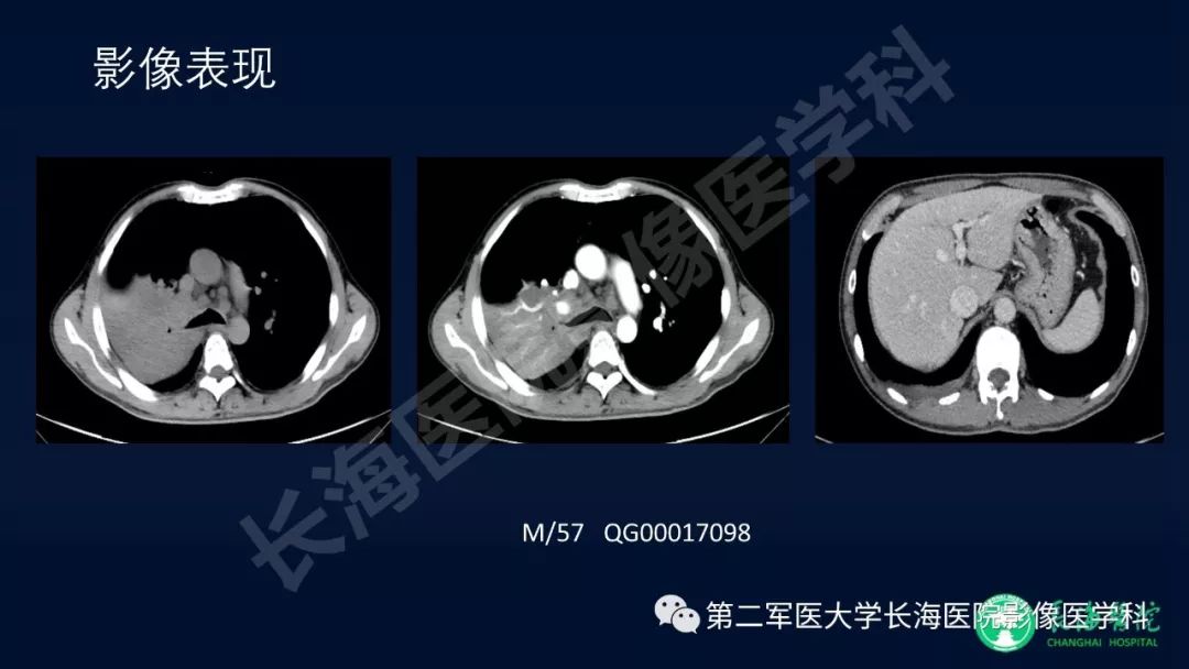 影像PPT - 【PPT】浅谈小细胞肺癌的影像诊断-38