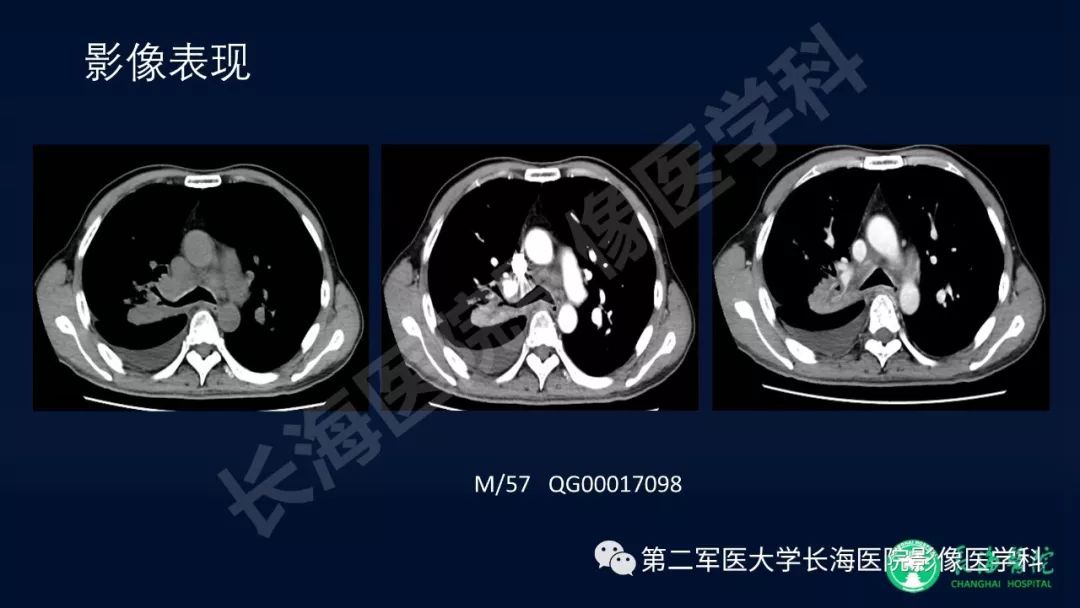 影像PPT - 【PPT】浅谈小细胞肺癌的影像诊断-39