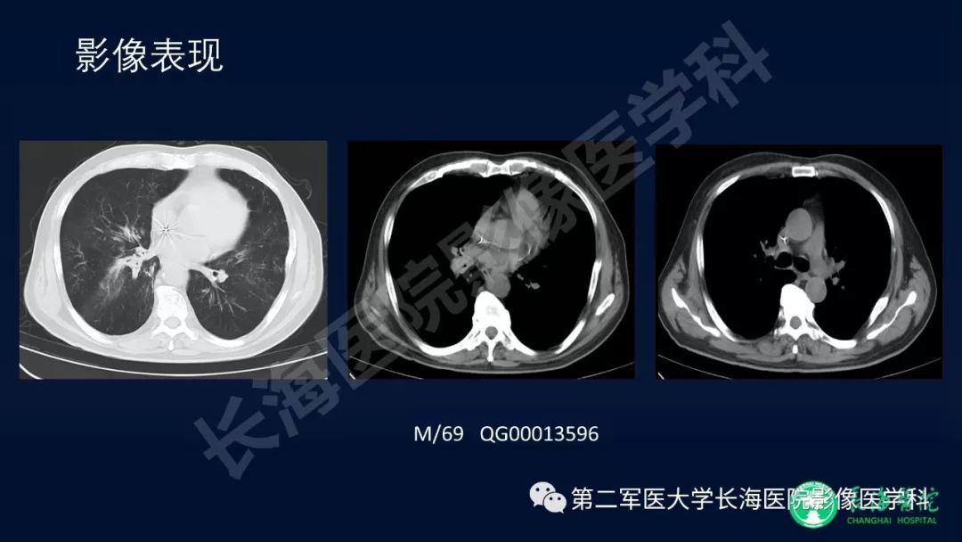 影像PPT - 【PPT】浅谈小细胞肺癌的影像诊断-40