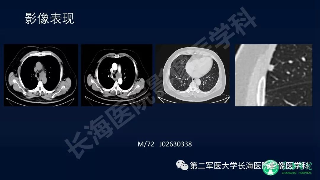 影像PPT - 【PPT】浅谈小细胞肺癌的影像诊断-42