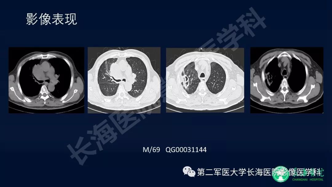 影像PPT - 【PPT】浅谈小细胞肺癌的影像诊断-43