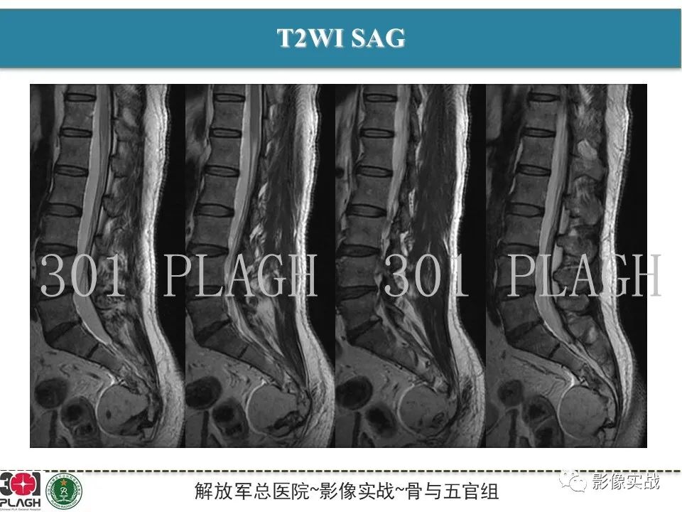 影像PPT - 【病例】骶尾部脊索瘤1例CT及MR影像-5