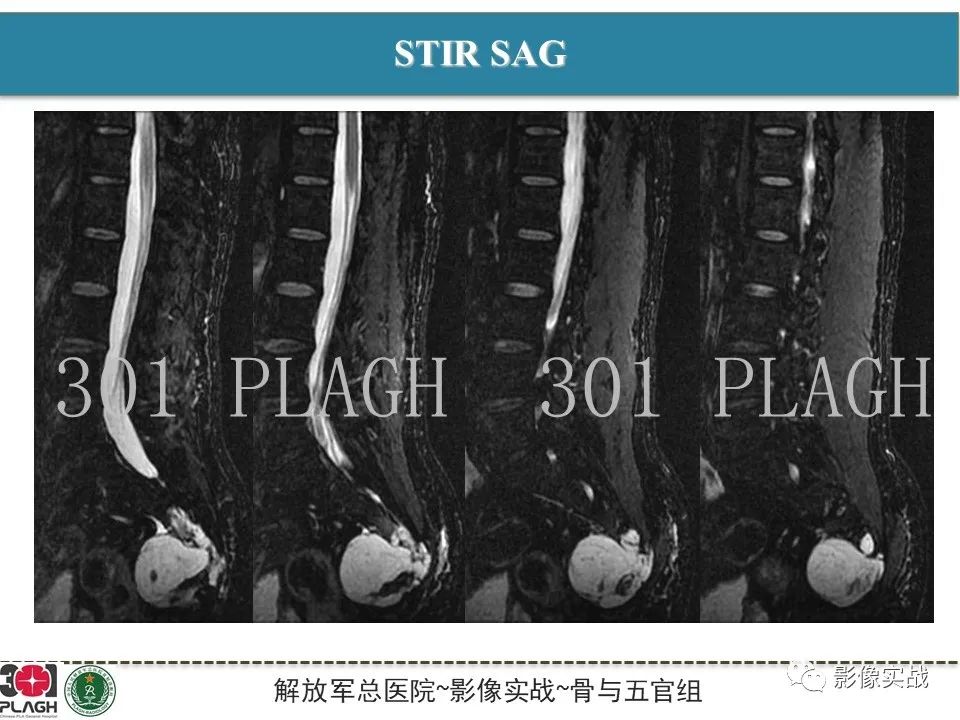 影像PPT - 【病例】骶尾部脊索瘤1例CT及MR影像-6