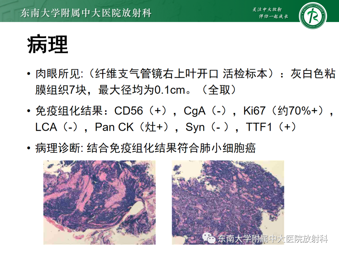 影像PPT - 【PPT】小细胞肺癌-3 影像PPT - 【PPT】小细胞肺癌-3
