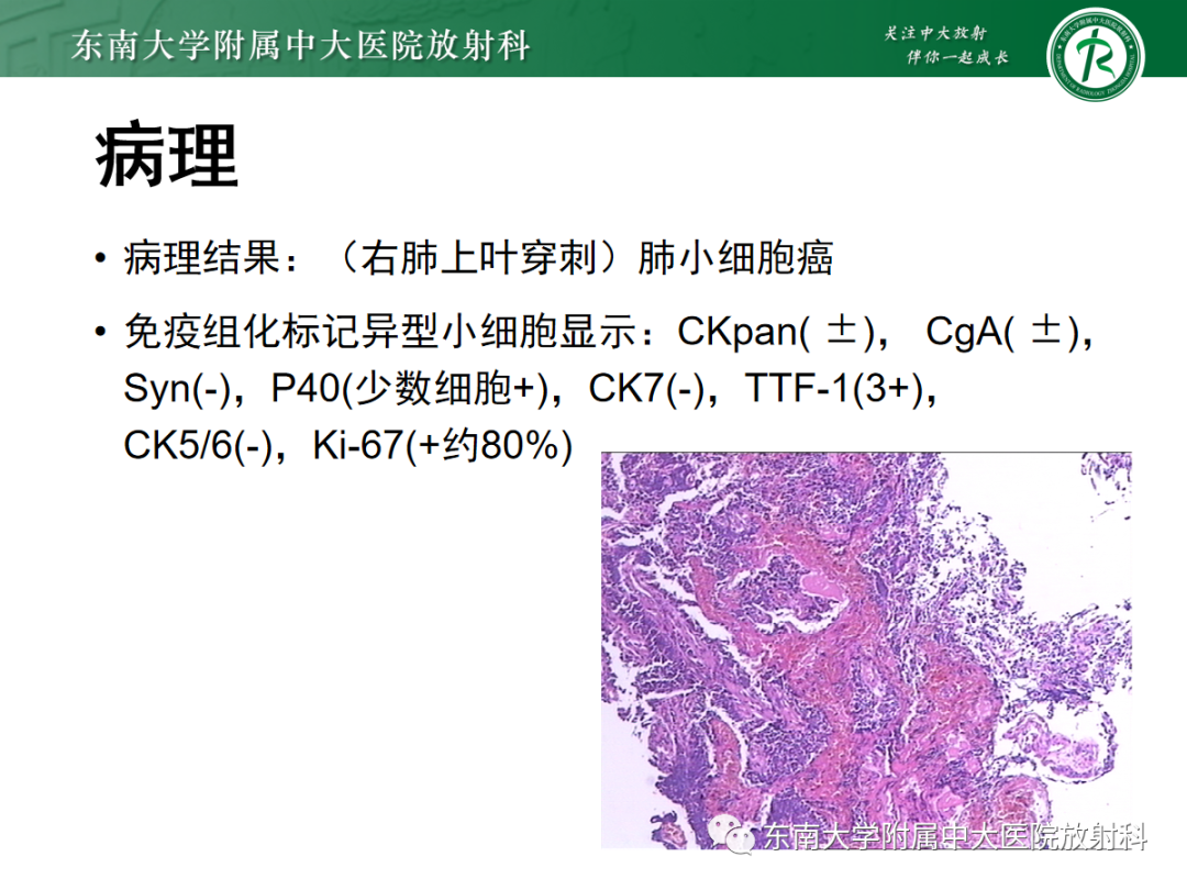 影像PPT - 【PPT】小细胞肺癌-10 影像PPT - 【PPT】小细胞肺癌-10