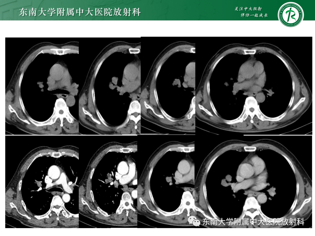 影像PPT - 【PPT】小细胞肺癌-9 影像PPT - 【PPT】小细胞肺癌-9