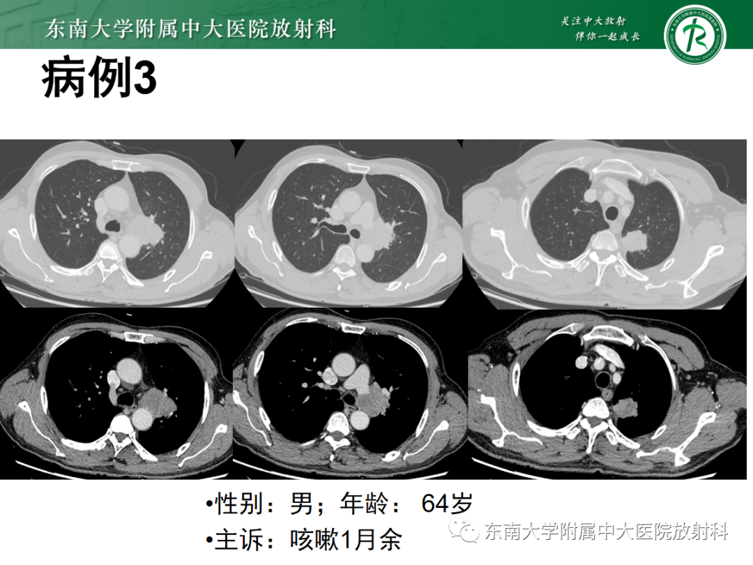 影像PPT - 【PPT】小细胞肺癌-14 影像PPT - 【PPT】小细胞肺癌-14