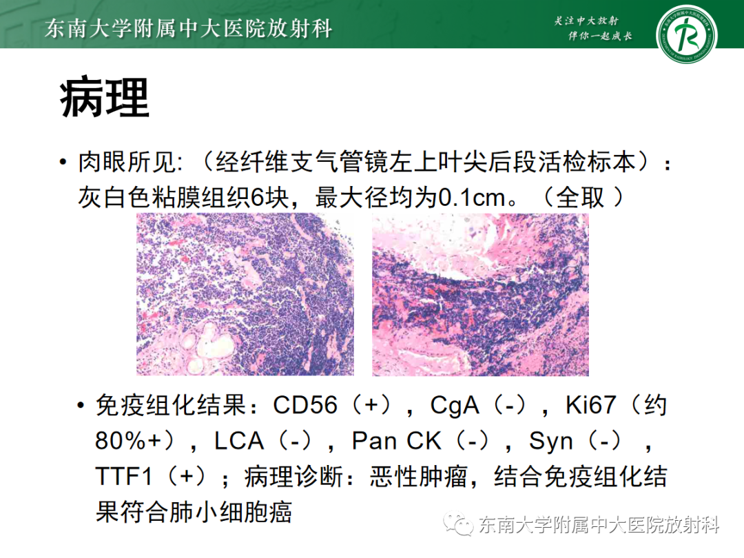 影像PPT - 【PPT】小细胞肺癌-15 影像PPT - 【PPT】小细胞肺癌-15