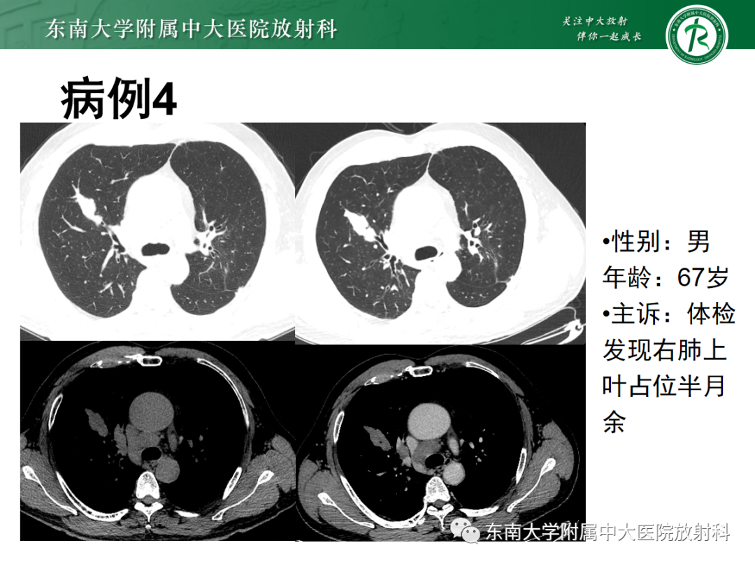 影像PPT - 【PPT】小细胞肺癌-17 影像PPT - 【PPT】小细胞肺癌-17