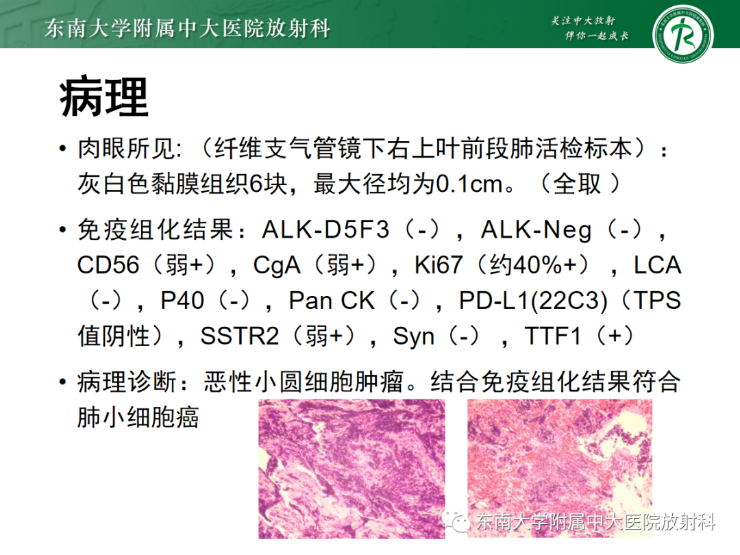 影像PPT - 【PPT】小细胞肺癌-18 影像PPT - 【PPT】小细胞肺癌-18