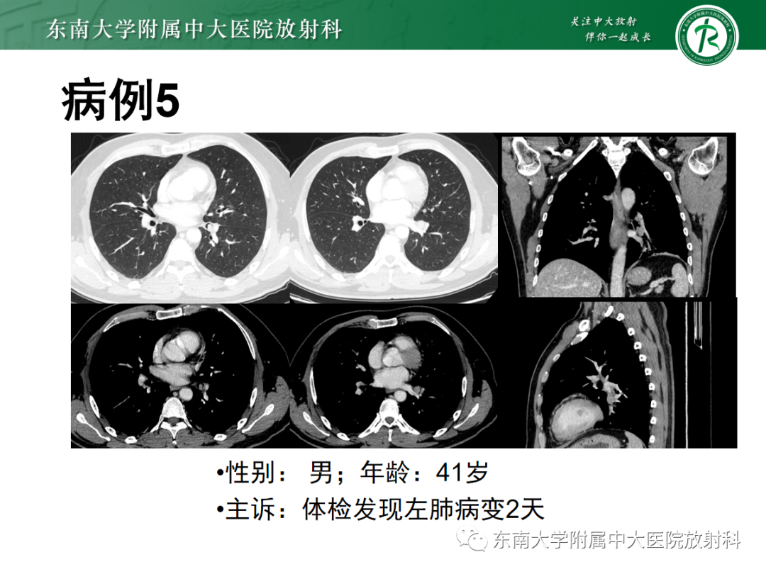 影像PPT - 【PPT】小细胞肺癌-20 影像PPT - 【PPT】小细胞肺癌-20