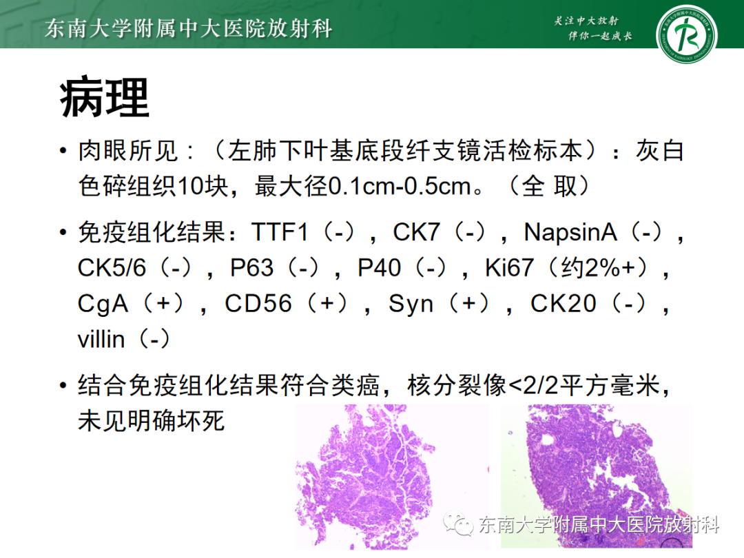 影像PPT - 【PPT】小细胞肺癌-21 影像PPT - 【PPT】小细胞肺癌-21