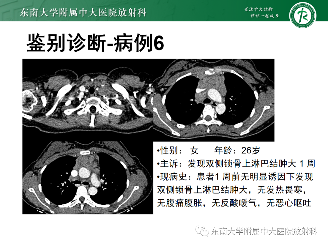 影像PPT - 【PPT】小细胞肺癌-23 影像PPT - 【PPT】小细胞肺癌-23